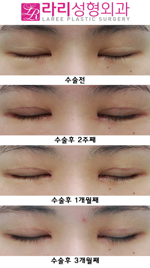 눈재수술  원인을 찾아서 ! (쌍재, 앞재, 뒤재로 해결) 관련 이미지 4
