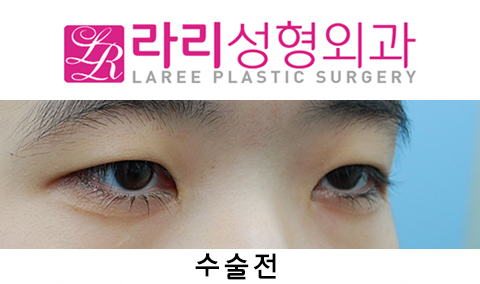 [라리성형외과] 절개쌍수 눈매교정 그리고 앞트임 관련 이미지 3