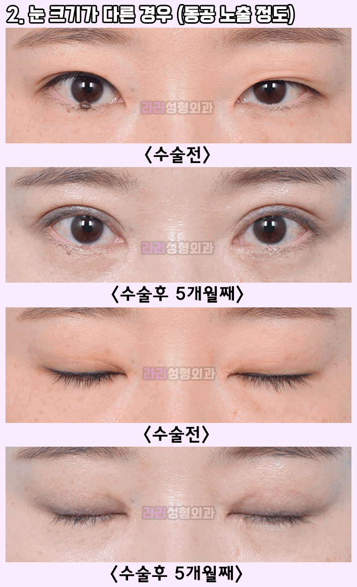 [라리성형외과] 쌍수후짝눈,  선천성짝눈 - 짝짝이쌍꺼풀의 비대칭 교정을 위한 눈성형 방법 관련 이미지 2