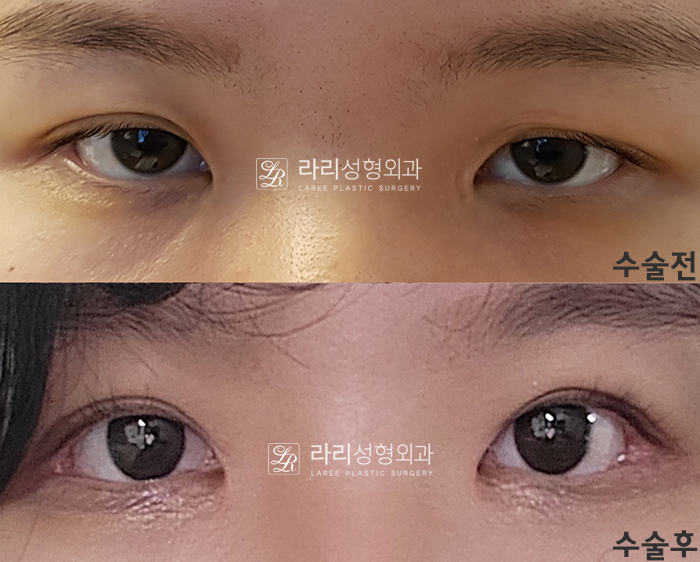 [라리성형외과] 쌍꺼풀수술 그리고 쌍꺼풀재수술 , 성공하려면 어디서 해야 할까요 !? 관련 이미지 2