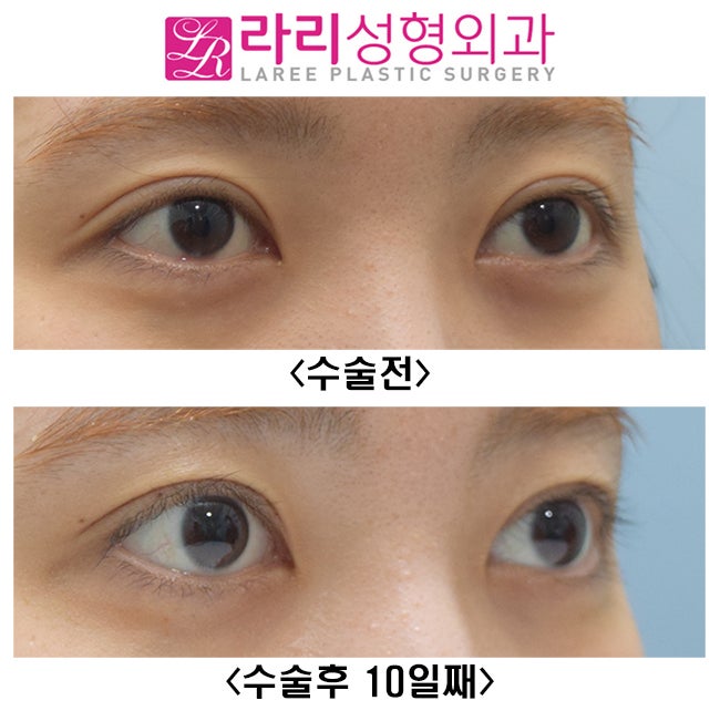 [Lari Plastic Surgery] Double Eyelid Revision Surgery with Line Lowering Combined with Ptosis Correction Surgery image 3