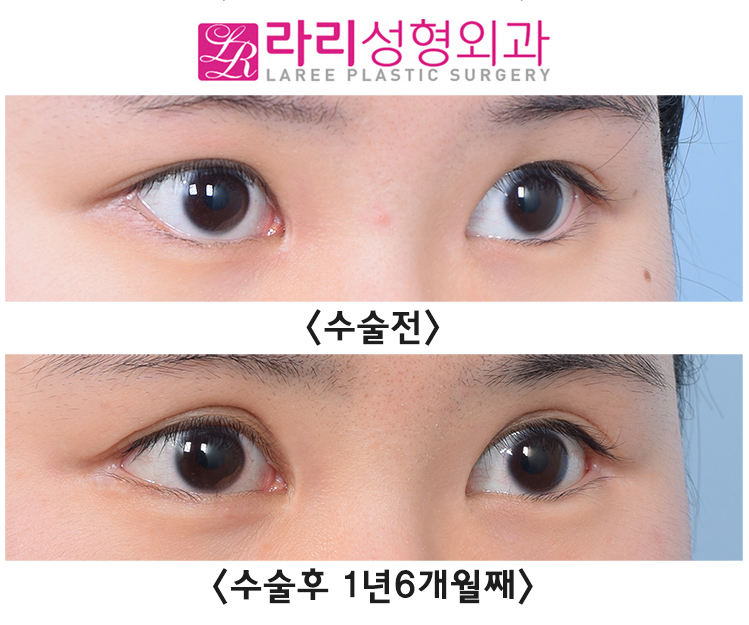 [Rari Plastic Surgery] Comparing the Before-and-After Effects of Lateral Canthoplasty Performed Together with Incisional Double Eyelid Surgery image 2