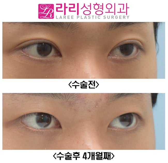 [라리성형외과] 쌍꺼풀없애기 그리고 눈두덩이 꺼짐 교정 (루프지방이식) 관련 이미지 4