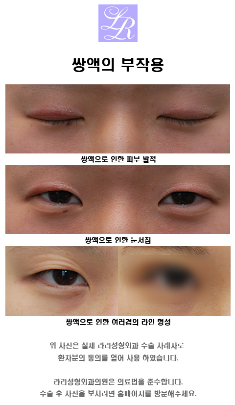 쌍꺼풀만들기 - 쌍액, 쌍테, 쌍수 뭘 해야하죠? 관련 이미지 1