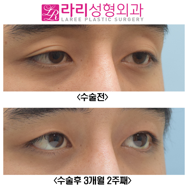 [라리성형외과] 쌍꺼풀 없애는 수술 받으면 쌍꺼풀 없애기 가능한가요..? 관련 이미지 2