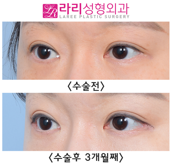 [라리성형외과] 뒤트임재수술 티 나게 잘하는 병원 라리성형외과 관련 이미지 3