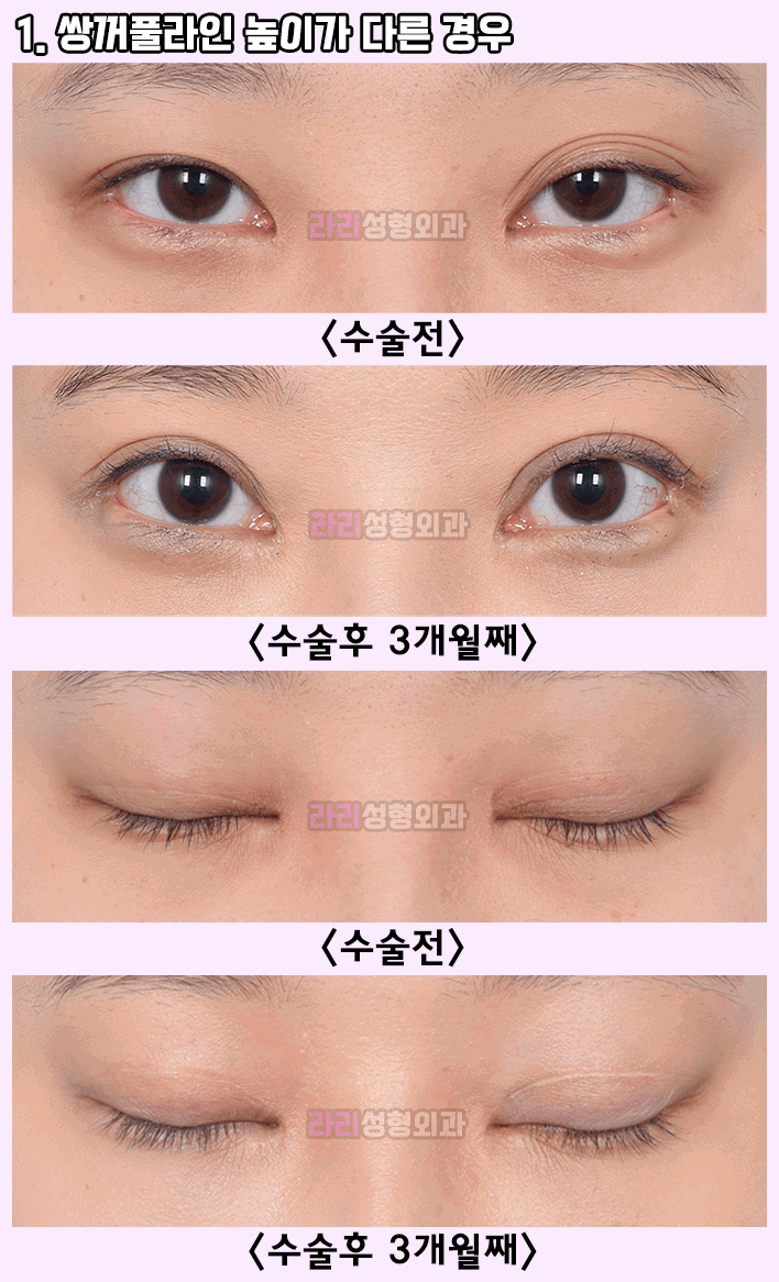 [라리성형외과] 쌍수후짝눈,  선천성짝눈 - 짝짝이쌍꺼풀의 비대칭 교정을 위한 눈성형 방법 관련 이미지 1