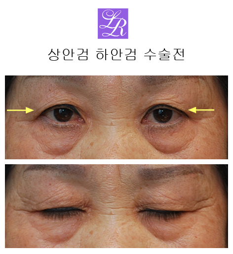 상안검수술, 하안검수술- 수술전후, 경과 궁금쓰 관련 이미지 2