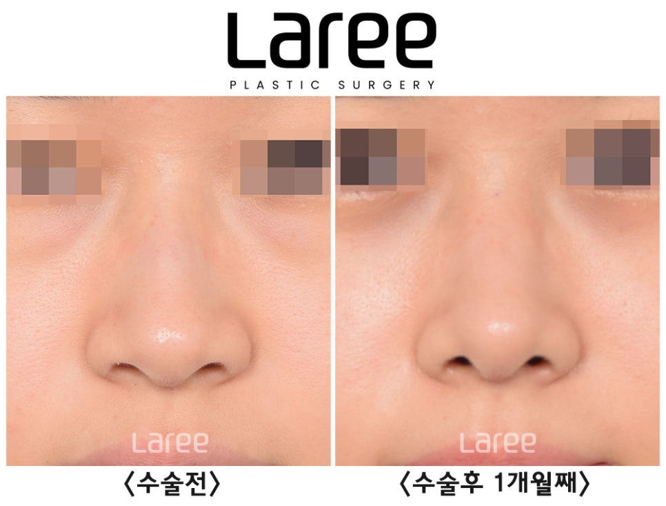 [Lari Plastic Surgery] Hump Nose Surgery Is Performed Naturally Without Implants. (No Implants, Septal Cartilage) image 5