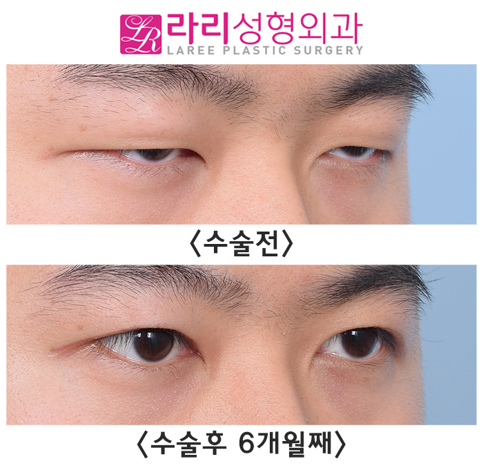 [Lari Plastic Surgery] Before-and-After Comparison Photos of Incisional Eye Correction Surgery That Restores Vision — Not from an Ophthalmology Clinic, but from a Plastic Surgery Clinic image 4