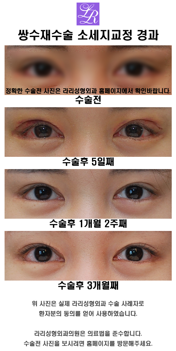 누구나 확인해야할 쌍수재수술후기 관련 이미지 2