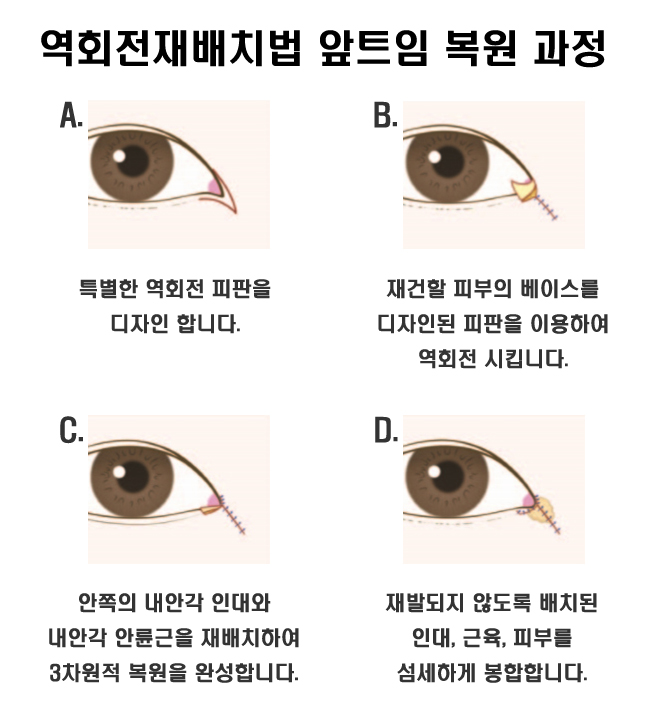 Understanding Medial Epicanthoplasty Revision Surgery - Methods Such as the Turnover Reverse Rotation Flap Technique image 3