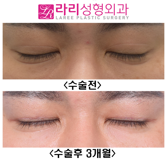 [라리성형외과] 원래 없었던 것처럼 보이는 자연쌍꺼풀없애기 관련 이미지 2