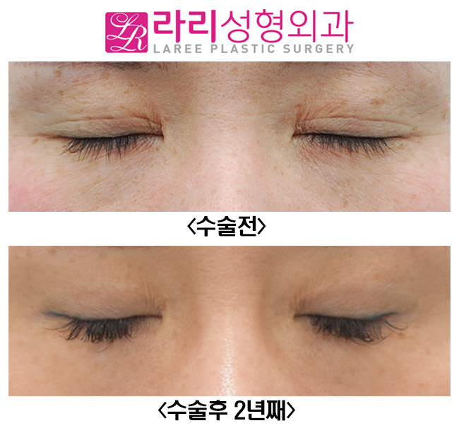 [라리성형외과] 아웃라인 쌍꺼풀재수술 화려하게 변화주기 관련 이미지 2