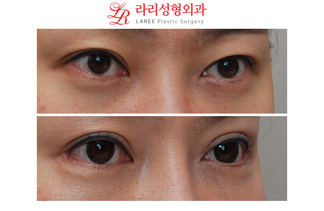 쌍꺼풀재수술 눈꼬리내리기뒤트임/눈꼬리내리기뒷트임 전후사진-※ 관련 이미지 2