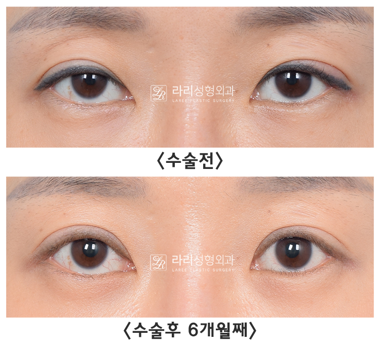 [라리성형외과] 아이홀 꺼짐 있는 눈 파악하고, 윗눈꺼풀 지방이식으로 교정 관련 이미지 13