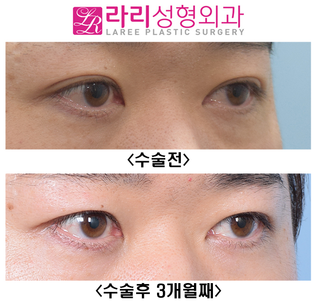 [Lari Plastic Surgery] Lowering the Line of Thick Natural Double Eyelids to a Deep-Eye Style That Looks Like No Double Eyelids image 4