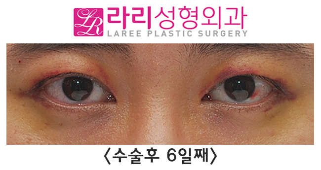 [라리성형외과] 쌍꺼풀없애는수술 단기 회복부터 장기 경과까지 관련 이미지 3
