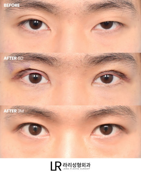 [Lari Plastic Surgery] Swelling After Double Eyelid Surgery: Why Does It Go Down Differently on Each Side? Will It Eventually Even Out? image 1