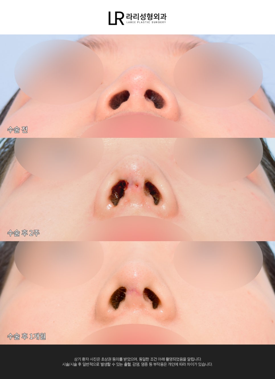 [Lari Plastic Surgery] If You Are Considering Nose Surgery, Do Not Get Nose Thread-Lifting Procedures Like Misko / Hiko!! image 9