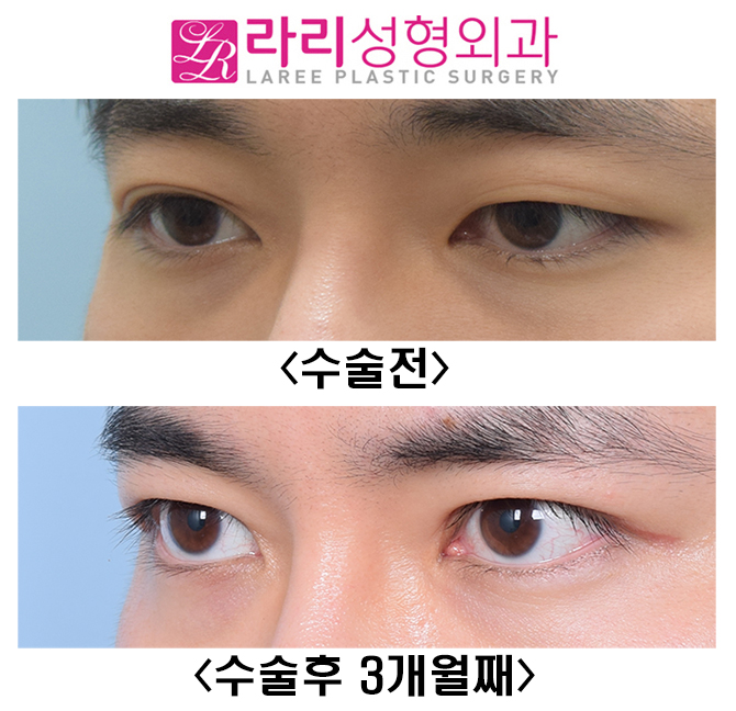 [Lari Plastic Surgery] Is it possible to have a distinct eye even with a hidden double eyelid?! (I don’t want uneven eyes) image 3