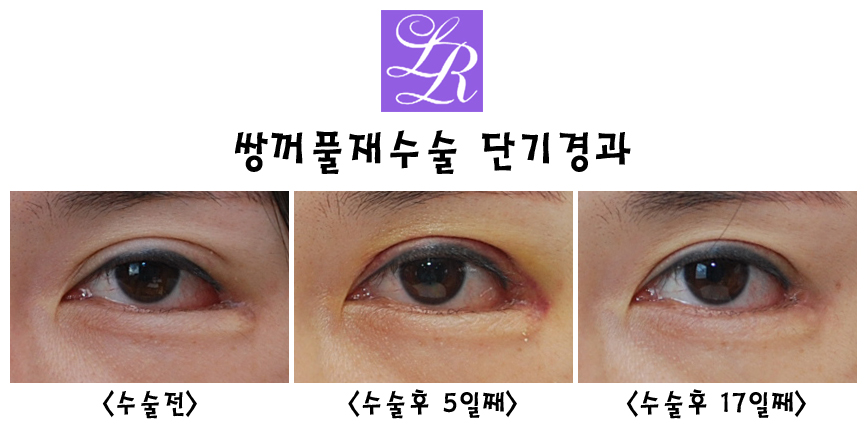 쌍꺼풀재수술 왜 필요한거죠? 라인교정, 붓기, 경과, 흉터교정 관련 이미지 1