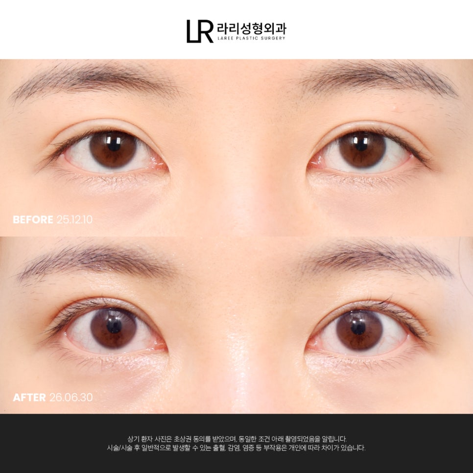 [라리성형외과] 쌍꺼풀수술 전후 사진으로 보는 눈매교정의 중요성 관련 이미지 7