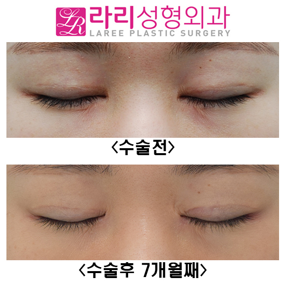 [라리성형외과] 쌍꺼풀재수술, 앞트임복원, 뒤트임재수술, 눈밑지방재배치재수술 전후 관련 이미지 4