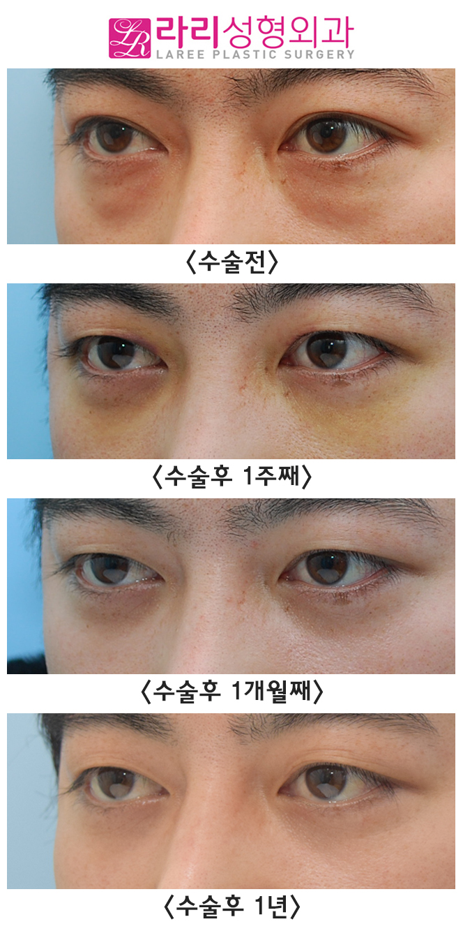 [Lari Plastic Surgery] Analysis of the Before-and-After Course of Non-Incisional Double Eyelid Removal Surgery, Which Is Effective but Has Weaknesses image 4
