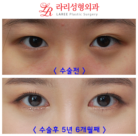 Epicanthoplasty: Is It Worth the Cost? image 2