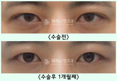 [Lari Plastic Surgery] Removing a Visible Double Eyelid (Double Eyelid Reversal Surgery), From Natural Double Eyelids to Surgical Double Eyelids: A to Z image 13