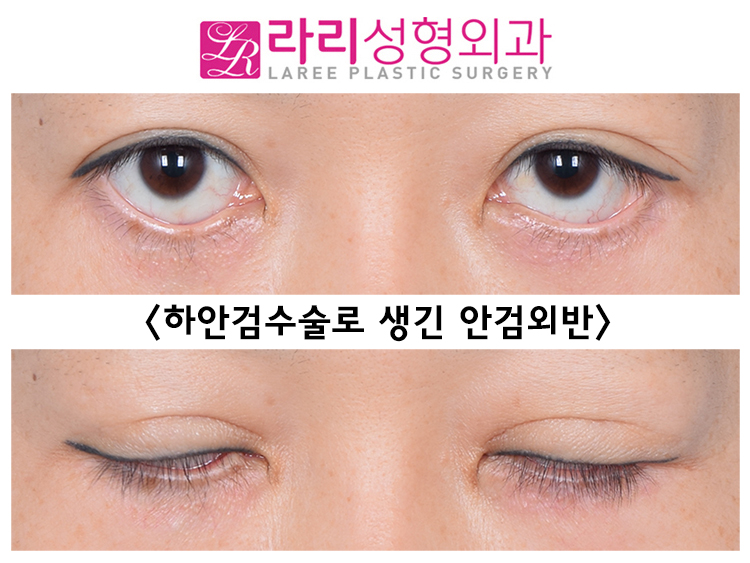 [Lari Plastic Surgery] Lower blepharoplasty including entropion correction, the most common cause of iatrogenic ectropion image 8