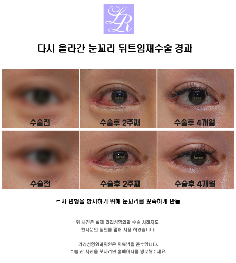 뒤트임재수술 - 안검내반 교정, 2주와 4개월, 1년 경과 관련 이미지 2