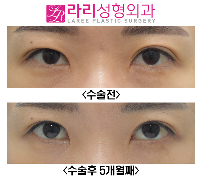 [라리성형외과] 눈매교정이 함께 필요한 쌍꺼풀재수술, 비대칭 눈교정 전후사진 관련 이미지 1