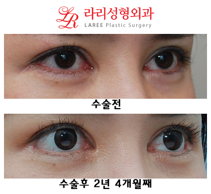 Total Eye Plastic Surgery Care (Ptosis Revision Surgery, Epicanthoplasty Restoration, Revision Lateral Canthoplasty) image 3