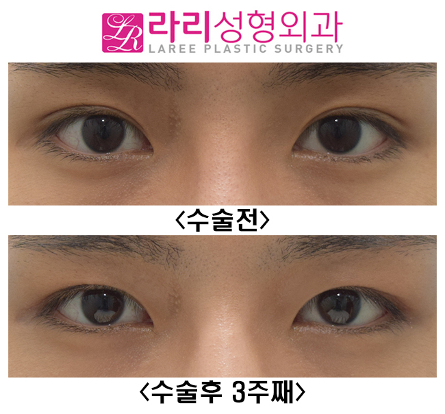 [라리성형외과] 인아웃라인 자연쌍꺼풀을 무쌍속쌍으로 만들기 관련 이미지 1