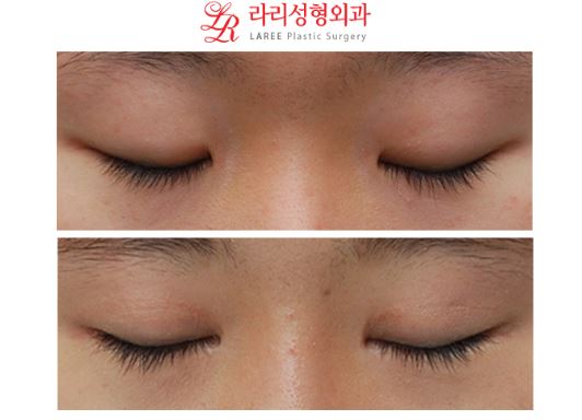 ☆왕눈이 수술 전후사진☆ 관련 이미지 2