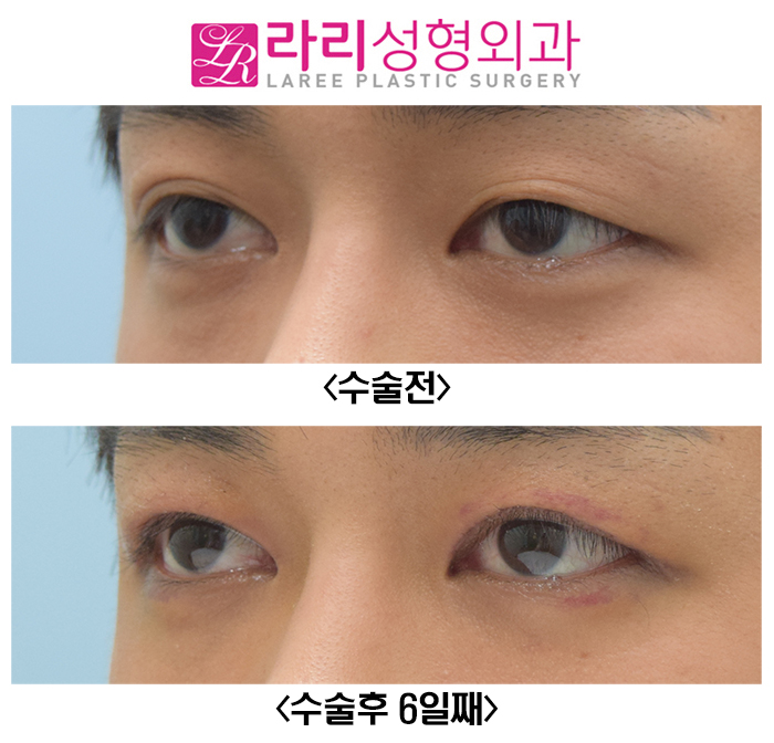 [라리성형외과] 쌍꺼풀없애는수술 전후사진 일주일이면 실밥 제거 관련 이미지 3
