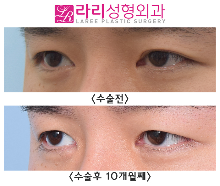 [라리성형외과] 눈이 조금 작아져도 괜찮다면 완전 무쌍으로 쌍꺼풀없애기 수술을 받아요. 쌍꺼풀없애기, 앞트임재수술, 뒤트임 수술 후 10개월째 관련 이미지 3