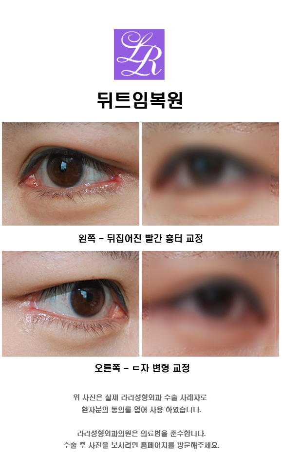 Lateral Canthoplasty Restoration - When Is the Reconstruction Timing Before and After Revision Surgery? image 3