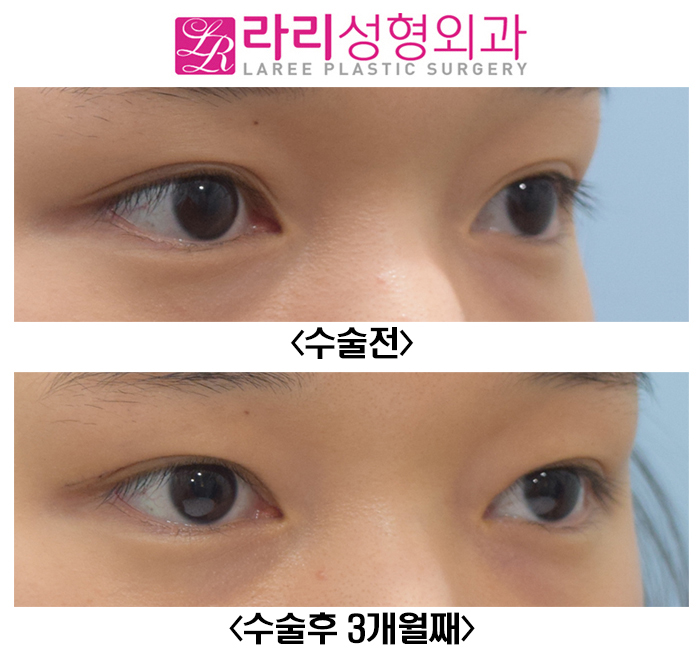 [Lari Plastic Surgery] Reducing the Double Eyelid Line from an Outline to an Inline for a Natural Look image 3