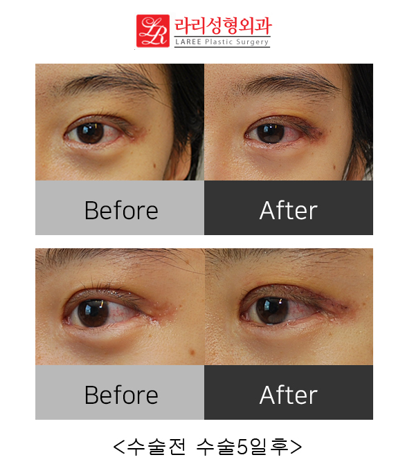 Correcting Double Eyelid Surgery Side Effects: Ectropion (feat. Rari Plastic Surgery) image 4
