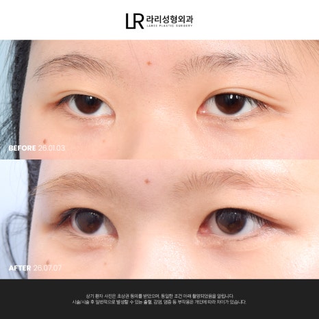 [라리성형외과] 쌍꺼풀수술 전후 사진으로 보는 눈매교정의 중요성 관련 이미지 9