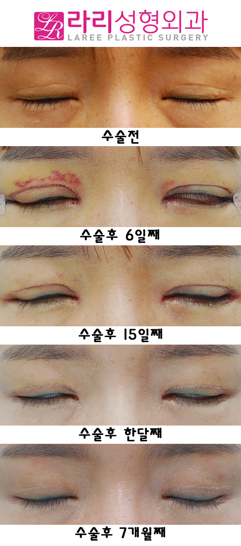 Sausage Correction, Epicanthoplasty, and Revision Surgery for Lateral Canthoplasty with Lowered Outer Eye Corners image 2