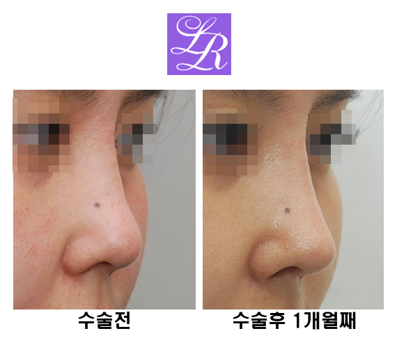 코재수술 코끝을 오똑하게 관련 이미지 3
