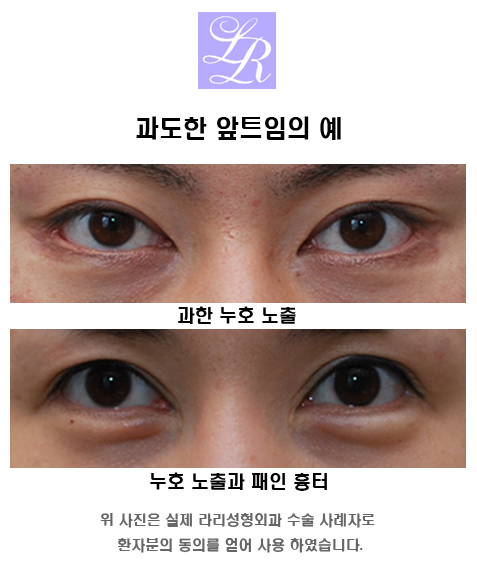 앞트임전후 많이 보면 도움이 될까 관련 이미지 1