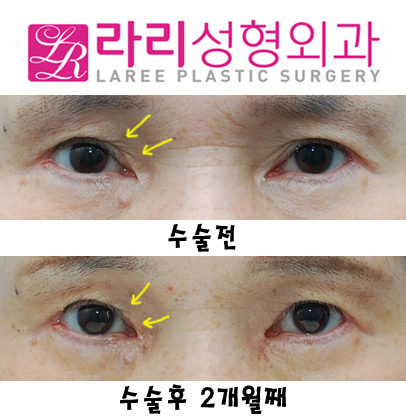 눈앞쪽 여러겹 쌍거풀없애기+뾰족한누호 둥글게 만들기 관련 이미지 2