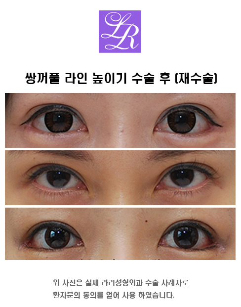 What Side Effects Can Occur After Double Eyelid Surgery? image 4