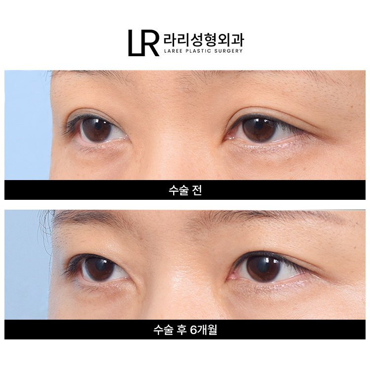 [라리성형외과] 흐릿한 눈, 소세지 쌍꺼풀 인라인 속쌍으로 깔끔하게 관련 이미지 1
