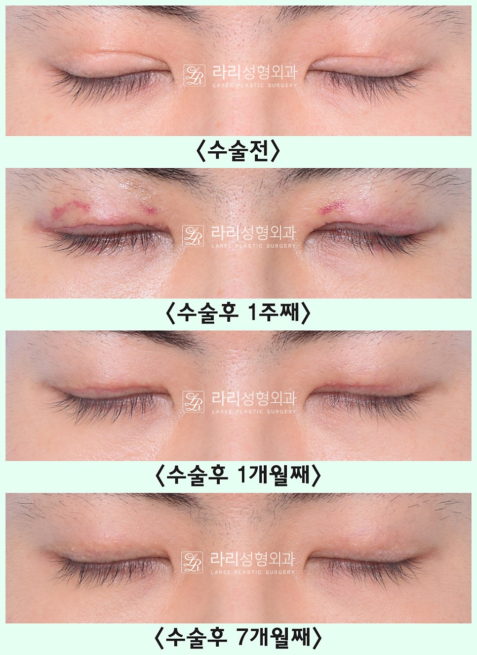 [Lari Plastic Surgery] Removing a Visible Double Eyelid (Double Eyelid Reversal Surgery), From Natural Double Eyelids to Surgical Double Eyelids: A to Z image 23